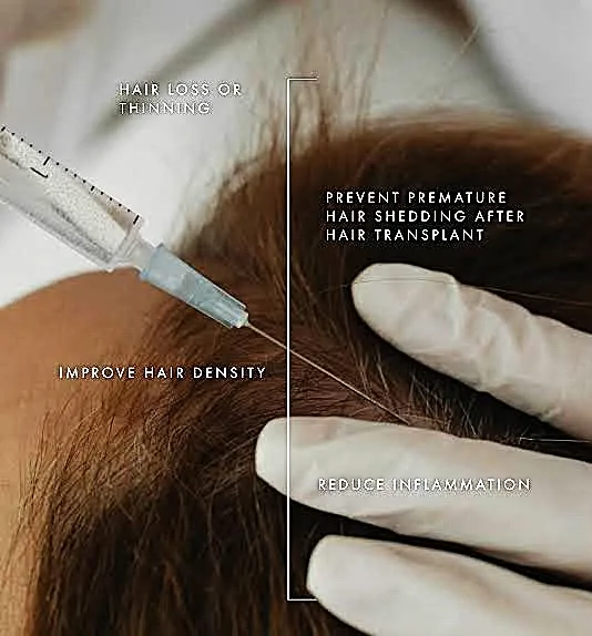 PRP Hair Treatment
